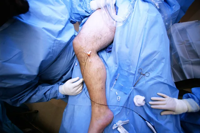 Điều trị giãn tĩnh mạch bằng sóng cao tần