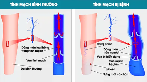 giãn tĩnh mạch là gì