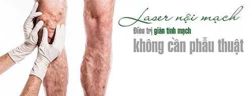 trị giãn tĩnh mạch
