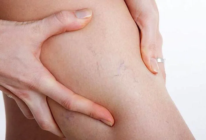 Massage có làm giảm triệu chứng giãn tĩnh mạch?