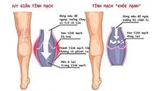gian tinh mach la gi