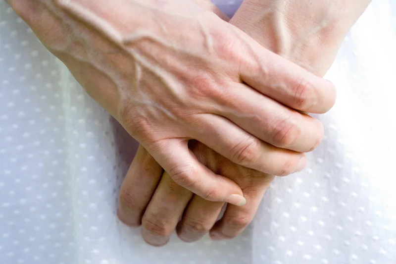 Nhiều phụ nữ mất tự tin vì giãn tĩnh mạch tay