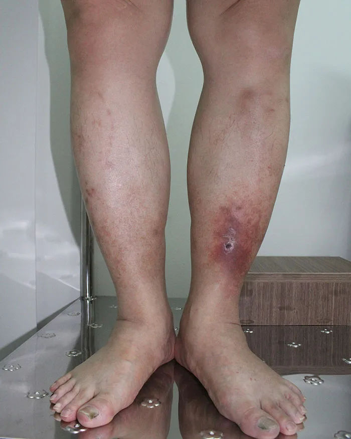 Loét chân do giãn tĩnh mạch: Biến chứng khó điều trị