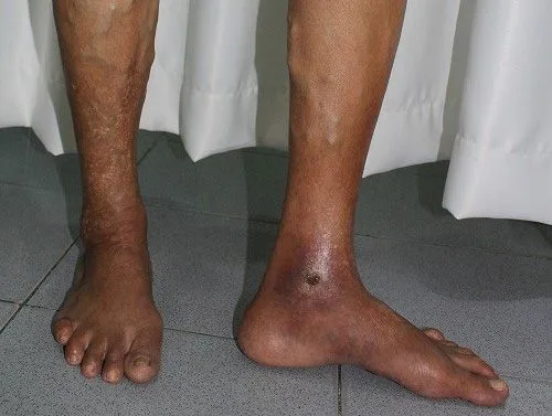 ĐỪNG ĐỂ LOÉT CHÂN DO GIÃN TĨNH MẠCH