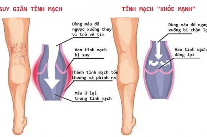 Kem bôi giãn tĩnh mạch có thật sự hiệu quả