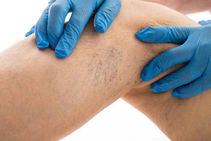 Vì sao nhiều người thích sử dụng kem bôi giãn tĩnh mạch