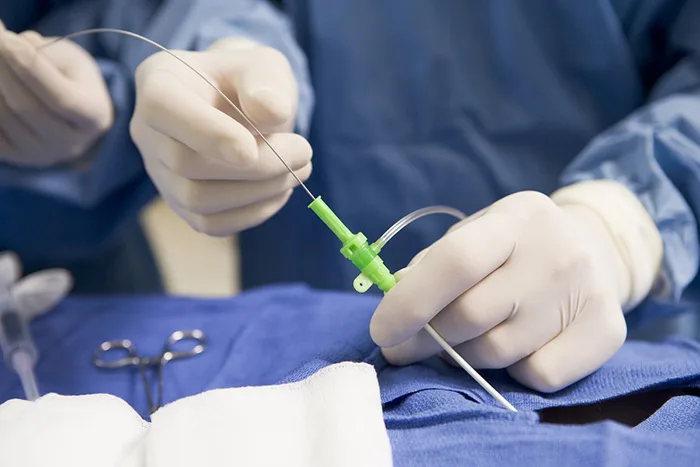 Loại bỏ tĩnh mạch bị suy giãn có ảnh hưởng đến sức khỏe?