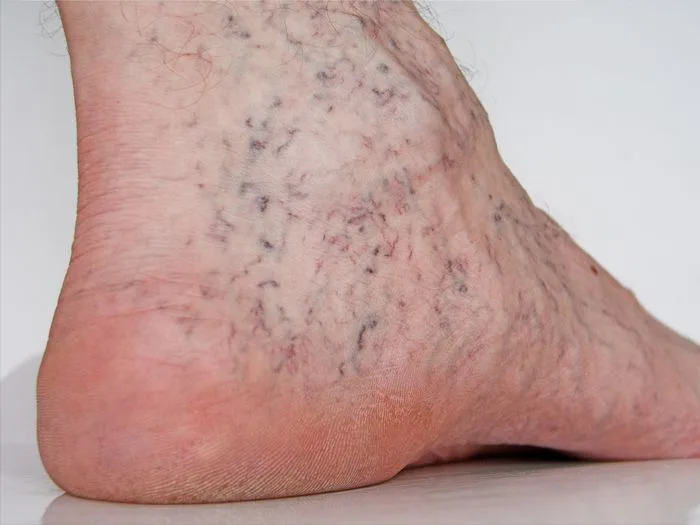 6 cấp độ giãn tĩnh mạch