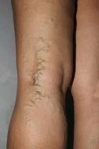 giãn-tĩnh-mạch-cấp-độ-2
