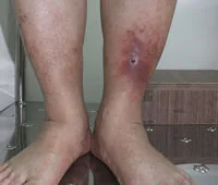 giãn-tĩnh-mạch-cấp-độ-5