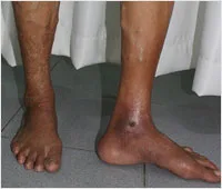 giãn-tĩnh-mạch-cấp-độ-5