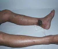giãn-tĩnh-mạch-cấp-độ-5
