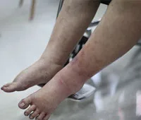 giãn-tĩnh-mạch-cấp-độ-3