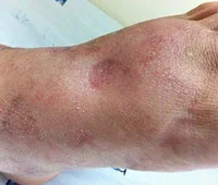 giãn-tĩnh-mạch-cấp-độ-3