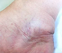 giãn-tĩnh-mạch-cấp-độ-3