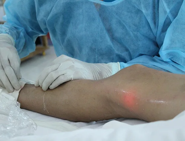 Laser nội mạch được chứng minh là hiệu quả và an toàn trong điều trị giãn tĩnh mạch