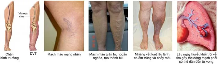 Lưu ý: Bệnh giãn tĩnh mạch chân có thể dẫn đến tử vong