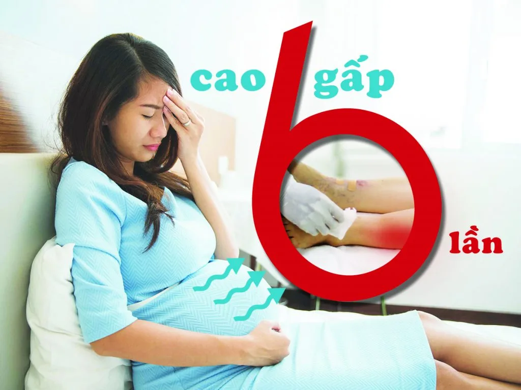 SGV Thai lưu