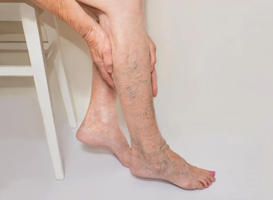 GIÃN TĨNH MẠCH CHI DƯỚI VÀ BIẾN CHỨNG