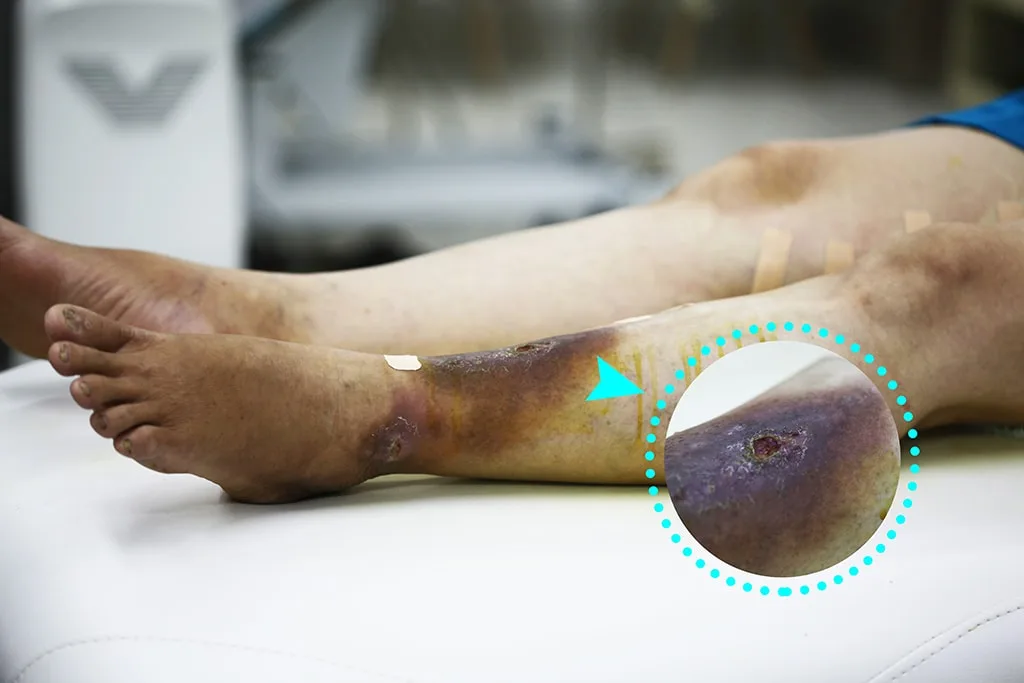 Bệnh giãn tĩnh mạch chân có nguy hiểm hay không?