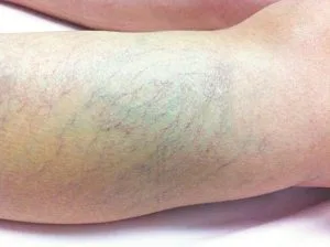 Bệnh giãn tĩnh mạch có nguy hiểm không