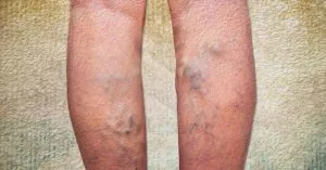 Cảnh báo bệnh suy tĩnh mạch hiện nay