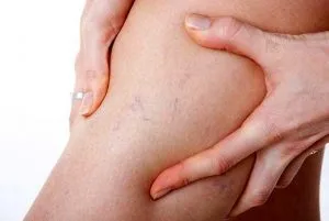 Khám và chữa bệnh suy giãn tĩnh mạch như thế nào Ở đâu
