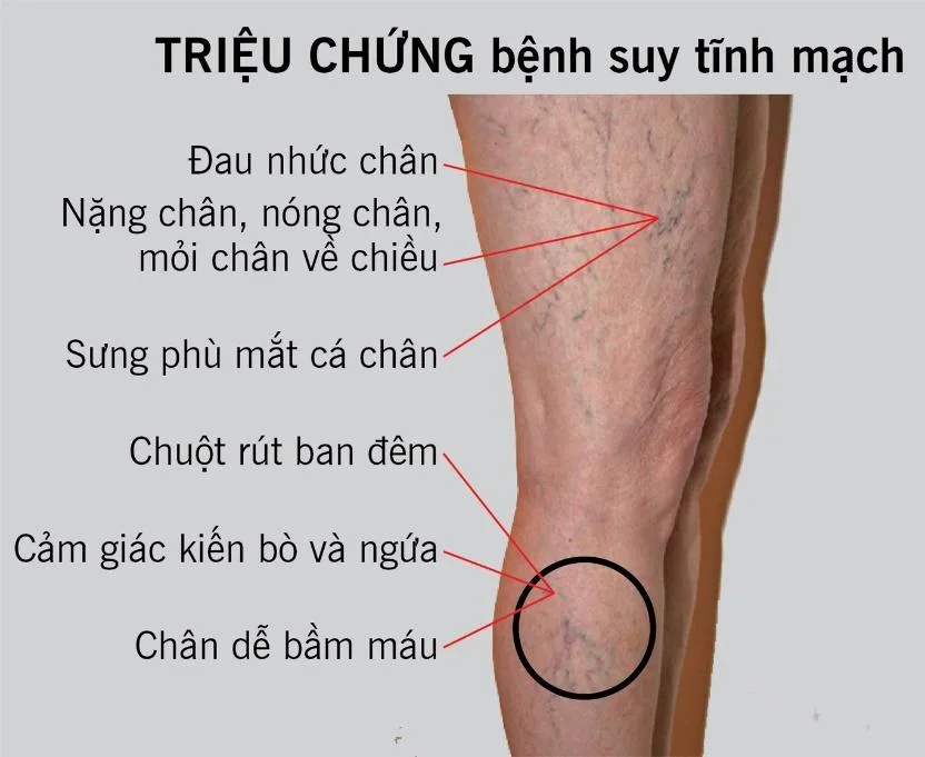 Một số thông tin về bệnh giãn tĩnh mạch chân mà bạn nên biết
