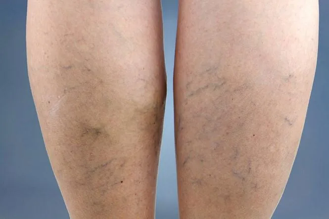 Điều trị suy giãn tĩnh mạch chân
