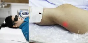cach dieu tri suy gian tinh mach chan