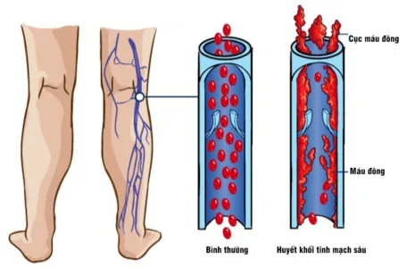 Những điều cần biết về bệnh suy van tĩnh mạch chi dưới