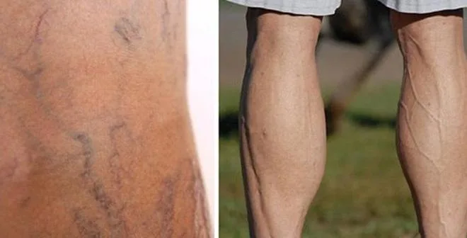 Nhận biết và cách chữa giãn tĩnh mạch chân kịp thời