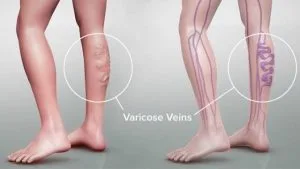 Những mẹo chữa bệnh giãn tĩnh mạch
