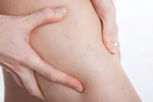 Những điều cần biết về bệnh với tĩnh mạch