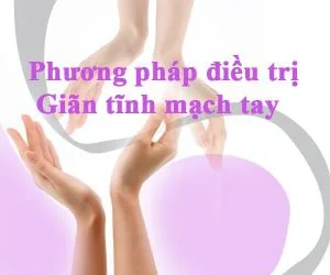 cach dieu tri gian tinh mach tay