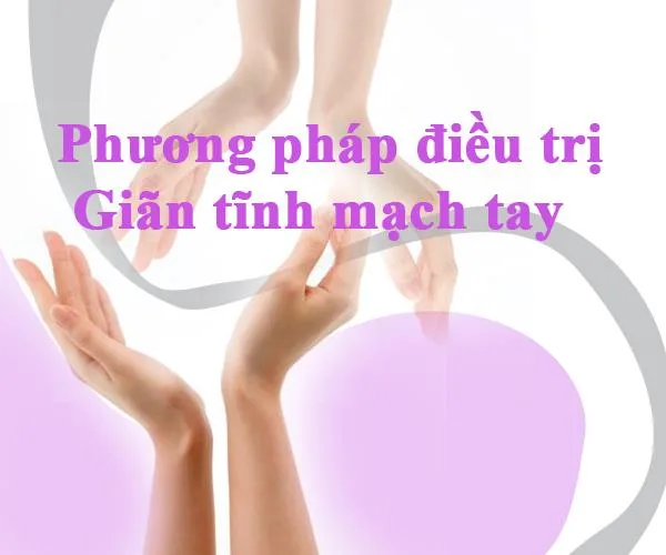 Cách điều trị giãn tĩnh mạch tay nhanh chóng