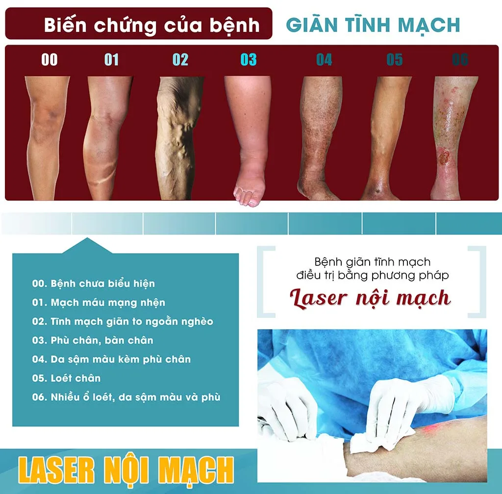 Những sai lầm trong việc chữa trị bệnh giãn tĩnh mạch chi dưới
