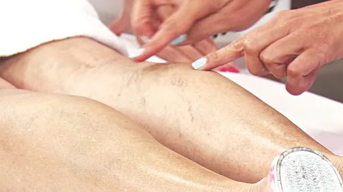 Nguyên nhân giãn tĩnh mạch chân mà bạn nên biết