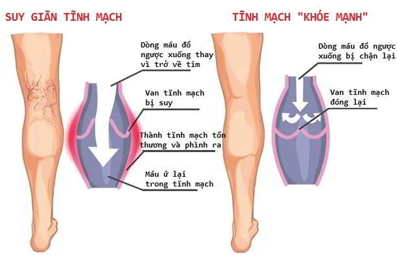 Nguyên nhân suy giãn tĩnh mạch là gì?