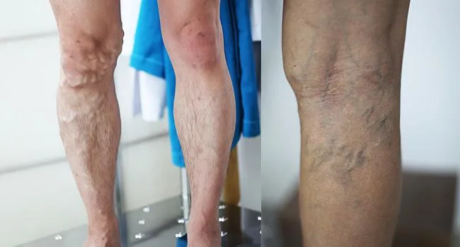 Những lưu ý về việc điều trị suy tĩnh mạch chi dưới