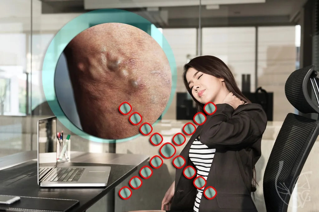 Mách bạn cách phòng chống bệnh suy giãn tĩnh mạch tại nhà đơn giản, hiệu quả