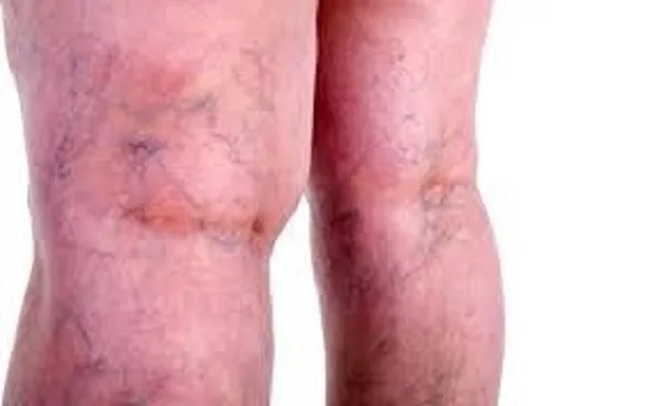 Cách điều trị bệnh giãn tĩnh mạch