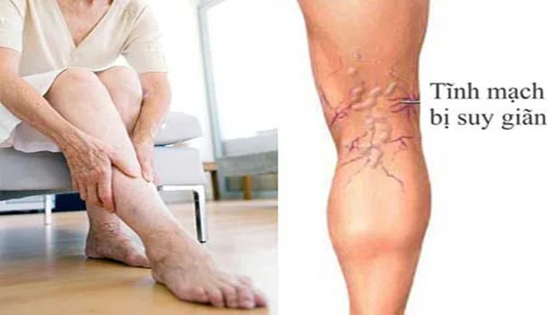 Căn bệnh suy tĩnh mạch có nguy hiểm không?