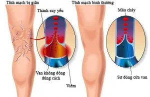 phong suy gian tinh mach chan