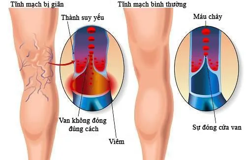 Cách phòng bệnh suy giãn tĩnh mạch chân