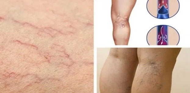 Căn bệnh giãn tĩnh mạch chân có nguy hiểm không?