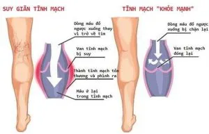 nguy co suy gian tinh mach
