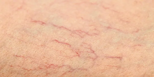 Những tác động sức khỏe đến từ việc vỡ tĩnh mạch dưới da