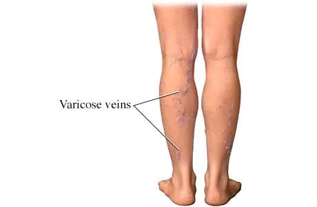 TRIỆU CHỨNG VÀ BIẾN CHỨNG CỦA BỆNH SUY GIÃN TĨNH MẠCH