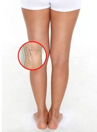 Tìm hiểu cách điều trị giãn tĩnh mạch chân hiệu quả